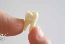 دیه دندان شیری
